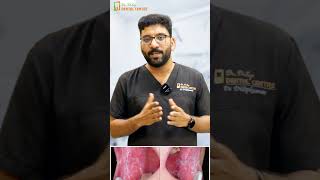 Understanding Oral Lichen Planus  Symptoms Causes and Care with Dr Dilip Kumar [upl. by Nathanson883]