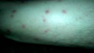 Chiggers Attacked on the 4th of July [upl. by Vories]