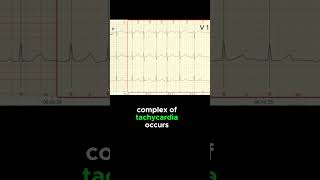 FOCAL ATRIAL TACHYCARDIA ECG EXAMPLE [upl. by Prissie426]