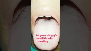 Swollen Tonsil  tonsillitis  shorts [upl. by Blumenthal380]