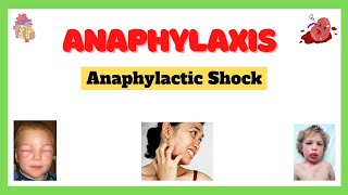 Anaphylactic Shock Anaphylaxis Signs and Symptoms Causes Complications Treatment Made Easy [upl. by Yarg]