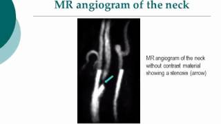 Your Radiologist Explains MR Angiography of the Brain and Neck [upl. by Einra]