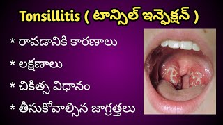 Tonsil Infectionటాన్సిల్ ఇన్ఫెక్షన్TonsillitisCauses  Symptoms and Treatment in Telugu [upl. by Godric]