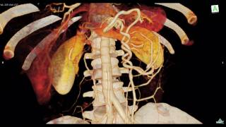 Intestinal malrotation CT Scan： 腸捻転 [upl. by Goda]