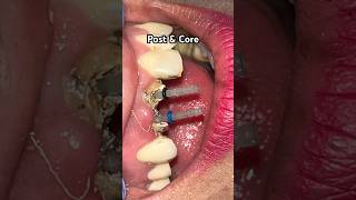 Post and Core Dental  Zirconia Crown Cementation  Anterior Post amp Core Build Up  Zirconia Crowns [upl. by Ellenehs998]