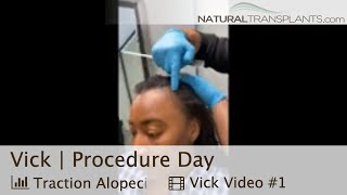 High Hairline Solution Hair Transplant Transforms Patients Hairline  Dr Blumenthal Vick [upl. by Jesselyn]