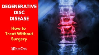 What is DEGENERATIVE DISC DISEASE  How to Treat It WITHOUT SURGERY [upl. by Plumbo]