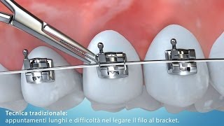 Video Animazione 3D tecnica di allineamento dentale con bracket [upl. by Hammad329]