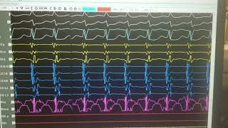 SVT differentiating AVNRT VS AVRT VS ATRIAL TACH [upl. by Alded]