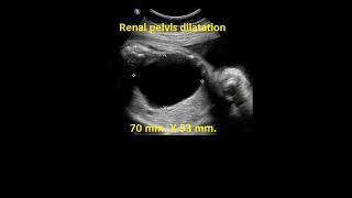 Fetal Pelvis and Skeleton with Common Malformations [upl. by Rolfston]