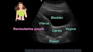 FAST Ultrasound Focused Assessment with Sonography for Trauma [upl. by Mcnalley]