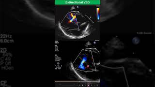 Bidirectional Ventricular Septal Defect Early Stage of Eisenmenger Syndrome [upl. by Ronyam309]