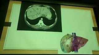 Reseccion Hepática y Pancreática  TECNICAS QUIRURGICAS [upl. by Cart]