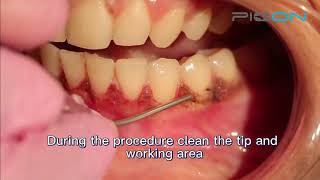 No bleeding and painfree laser gingival depigmentation procedure performed by Pioon dental laser [upl. by Teddman]