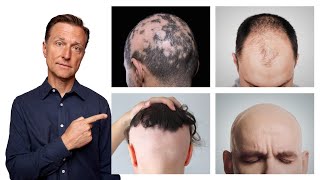 The 11 Types of Alopecia AND HOW TO FIX IT  Dr Berg [upl. by Colline385]