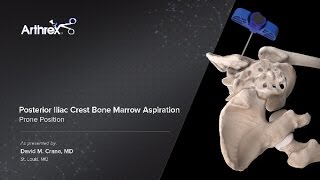 Posterior Iliac Crest Bone Marrow Aspiration  Prone Position [upl. by Eerised]