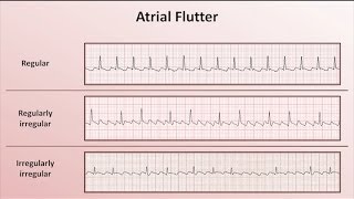 Intro to EKG Interpretation  Overview of Tachyarrhythmias [upl. by Assened]