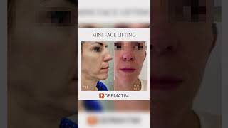 Mini face lifting Pre i Posle  Dermatološka poliklinika Dermatim [upl. by Chico]