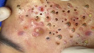 Big Cystic Acne Blackheads Extraction Blackheads amp Milia Whiteheads Removal Pimple Popping  2313 [upl. by Baggott]