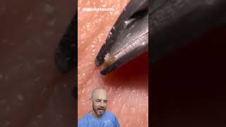 This ingrown hair removal is short and sweet credit blemishbandits on TT doctor satisfying [upl. by Eixor499]