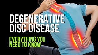 Degenerative Disc Disease  Everything You Need to Know [upl. by Faunia]