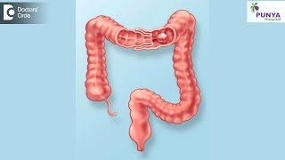 What is the treatment for Intussusception  Dr Nagaraj B Puttaswamy [upl. by Vida]