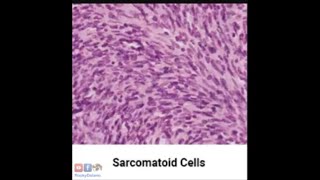 Sarcomatoid Mesothelioma Asbestos Mesothelioma Attorney 7 [upl. by Ades324]