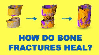 Bone tissue engineering  Bone healing [upl. by Hakaber847]