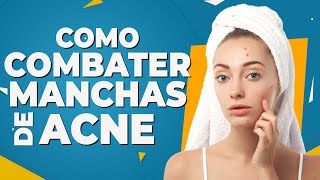 Como Combater Manchas de Acne  Dr Lucas Fustinoni [upl. by Ardnala124]