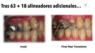 Claves de Éxito en Exodoncia Asimétrica y distalamiento secuencial con Invisalign [upl. by Gordie]