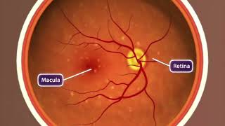 Animation Agerelated Macular Degeneration [upl. by Akehsat]