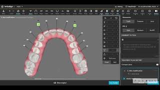 Experienced Invisalign orthodontists might benefit from this clincheck pearl [upl. by Allys639]