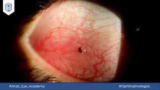 Educational Video 38 Conjunctival FB removal under slit lamp [upl. by Hayifas]