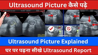 Ultrasound Picture Explained  Ultrasound Report In Hindi  Sonography Pictures [upl. by Isiahi]