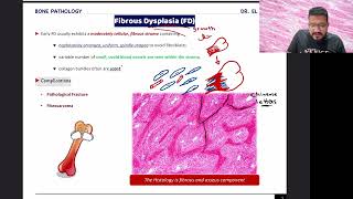 Fibrous Dysplasia  Paget Disease  Brown Tumor Osteitis Fibrosa Cystica [upl. by Horst]