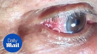 GRAPHIC Moment 15cm long worm is removed from mans eye [upl. by Ddene]