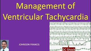 Management of Ventricular Tachycardia [upl. by Aevin]