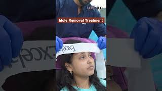 ✨ Patient Review on Mole Removal Treatment  moleremoval bestskinclinicinpune dermatologist [upl. by Addy]