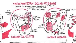 Inflammatory Bowel Disease  Crohns and Ulcerative Colitits [upl. by Enihpesoj484]