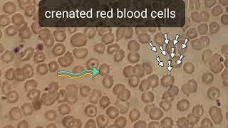 Crenation in blood film smear shows numerous of Burr cells or crenated red blood cells echinocytes [upl. by Dorrehs]