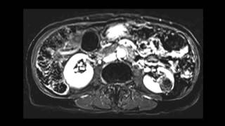 Angiomyolipoma AML of kidney [upl. by Porche385]