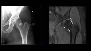 What is an MRI hip arthrogram [upl. by Sclater]