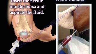 Aspiration Of Elbow Bursitis  Everything You Need To Know  Dr Nabil Ebraheim [upl. by Nosoj]