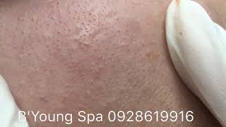 Removed blackheads by BYoung Spa part5 [upl. by Acinahs744]