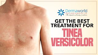 Get The Best Treatment for Tinea Versicolor [upl. by Ettelrac]