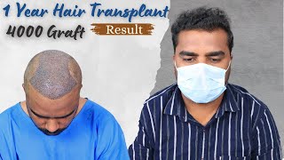 Hair Transplant Result  IFUE Hair Transplant Before amp After  4000 Grafts Hair Transplant Result [upl. by Lunneta117]