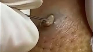 2020 Comedones Popping Dermatology Blackheads Zits and Whiteheads Cysts [upl. by Eikcin723]