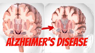 The Anatomy and Physiology of Alzheimer’s Disease Understanding the Brains Changes [upl. by Colombi]