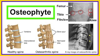 osteophyte [upl. by Haerr]