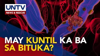 Pagkakaroon ng kuntil o polyps sa bituka posibleng mauwi sa colon cancer – expert [upl. by Nrobyalc]